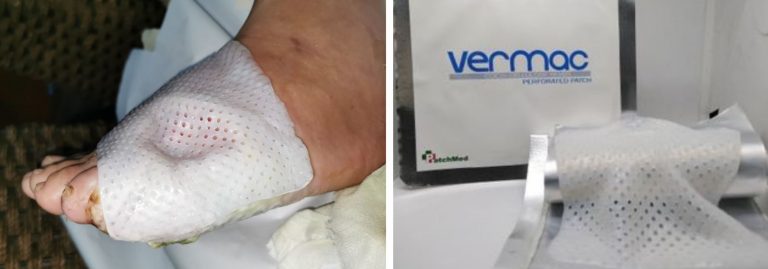 Filipino Nurse Develops Wound Patch For Diabetics Made From Coconut filipino-nurse-develops-wound-patch-for-diabetics-made-from-coconut